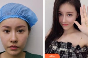 廣州博仕整形美容醫(yī)院李少顏整形價(jià)格表附假體墊眉弓案例展示