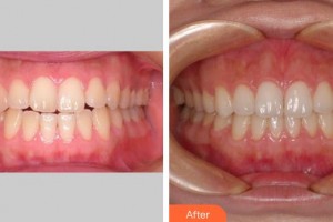 上海一美整形外科醫(yī)院　張社濱整形價格表附牙齒正畸案例展示