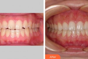 廣州金沙洲醫(yī)院整形科（原白云山）杜本軍整形價格表附牙齒正畸案例展示