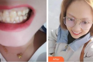 上海一美整形外科醫(yī)院　鮮運科整形價格表附烤瓷牙牙齒貼面案例展示