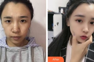 上海東方麗人美容醫(yī)療醫(yī)院李哲整形價格表附安琪拉芭比眼案例展示