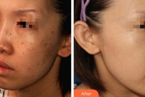 廣州美萊醫(yī)療美容醫(yī)院潘萍整形價格表附曬斑調(diào)節(jié)案例展示