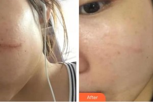 上海仁愛醫(yī)院整形美容科彭才學(xué)整形價格表附點陣祛疤痕案例展示