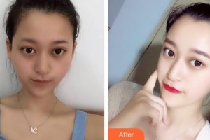上海麗人整形美容醫(yī)院王小兵整形價格表附顴骨降低案例展示