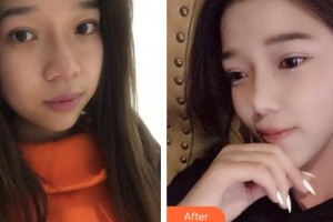 上海麗人整形美容醫(yī)院謝影影整形價格表附超激光美膚祛斑案例展示