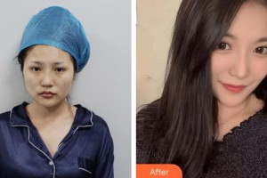 上海麗人整形美容醫(yī)院郭建華整形價格表附黃金微雕全臉案例展示