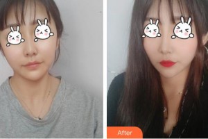 上海麗人整形美容醫(yī)院崔潔整形價格表附無針水光案例展示