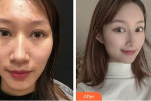 上?？祳W醫(yī)療美容醫(yī)院趙華整形價格表附微針祛痘案例展示