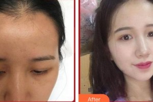 上?？祳W醫(yī)療美容醫(yī)院白俊杰整形價格表附發(fā)際線種植案例展示