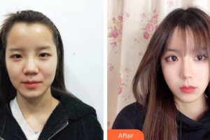 上海康奧醫(yī)療美容醫(yī)院錢麟整形價格表附美鼻部手術案例展示