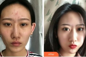 上海康奧醫(yī)療美容醫(yī)院袁智娟整形價格表附激光去紅血絲案例展示