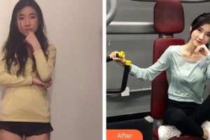 三門峽常亮醫(yī)療美容診所鄭東海整形價格表附玻尿酸導入案例展示