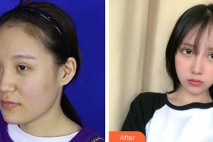 珠海華澳醫(yī)療美容整形門診部鄧強整形價格表附鼻部手術(shù)案例展示