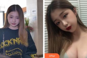 中山百佳婦產(chǎn)醫(yī)院醫(yī)療美容科李韻芳整形價格表附假體隆胸案例展示