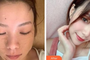 廣州時光整形美容醫(yī)院宋靜整形價格表附埋線提升案例展示