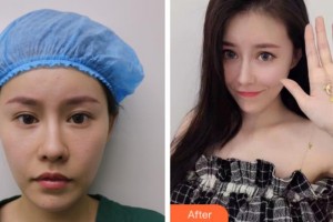 上海玫瑰醫(yī)療美容醫(yī)院尹仁大整形價格表附假體隆下頦案例展示