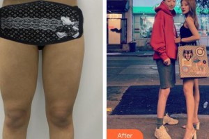 廣州美恩整形美容醫(yī)院徐元整形價格表附大腿吸脂案例展示