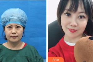 三門峽常亮醫(yī)療美容診所常亮整形價格表附不開刀祛眼袋+自體脂肪填充淚案例展示