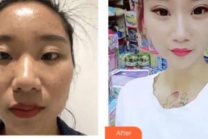 武警上?？傟?duì)醫(yī)院整形美容中心曹慧整形價(jià)格表附激光祛斑美白肌膚案例展示