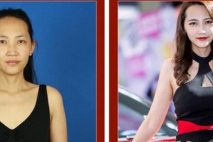 武警上?？傟?duì)醫(yī)院整形美容中心王慕 整形價(jià)格表附自體脂肪隆胸案例展示