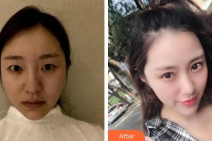 廣州美恩整形美容醫(yī)院高卿豪整形價格表附眼部綜合案例展示