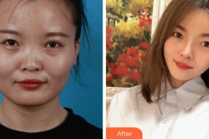 上海美之源整形外科醫(yī)院趙敏整形價(jià)格表附臉型（顴骨+下頜角）+鼻部手術(shù)案例展示