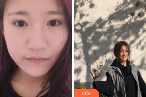 廣州凱美達整形美容醫(yī)院王之光整形價格表附無針水光案例展示