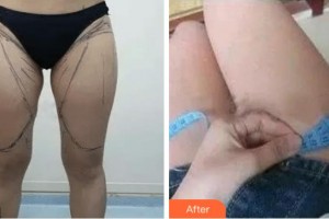 上海愛慕整形外科門診部何永強(qiáng)整形價(jià)格表附吸脂減大腿案例展示