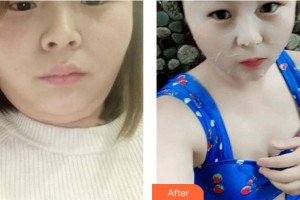 上海美之源整形外科醫(yī)院吳慶貞整形價(jià)格表附光子嫩膚案例展示