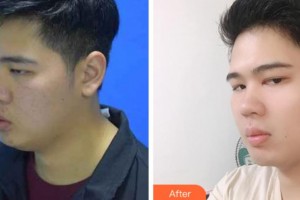 上海美立方整形醫(yī)院金秀哲整形價(jià)格表附縮脂針案例展示