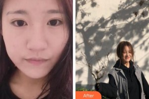 廣州軍頤醫(yī)院整形美容中心石建薇整形價格表附無針水光案例展示