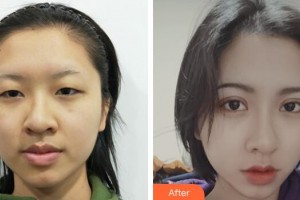 廣州軍區(qū)總醫(yī)院全軍激光整形美容中心熊杰整形價格表附眼部整形案例展示