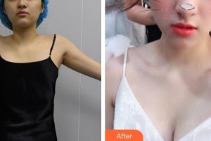 上海藝星醫(yī)療美容醫(yī)院郭仁洙整形價(jià)格表附自體脂肪隆胸案例展示