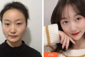 上海藝星醫(yī)療美容醫(yī)院崔海天整形價(jià)格表附下頜角磨骨案例展示