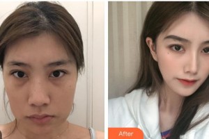 上海港華醫(yī)療美容醫(yī)院黃家海整形價(jià)格表附下頜角切除案例展示