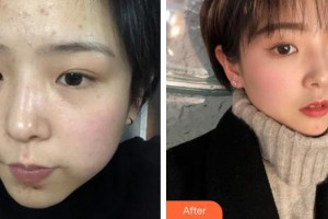 上海富華醫(yī)療美容醫(yī)院宋盈澄整形價(jià)格表附點(diǎn)陣激光療程去除痘印痘坑案例展示