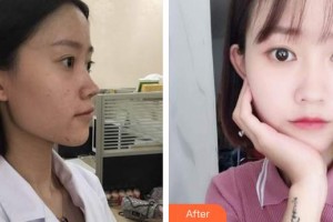 上海港華醫(yī)療美容醫(yī)院陳冰冰整形價(jià)格表附嫩膚淡斑微針案例展示