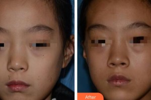 廣州軍頤醫(yī)院整形美容中心曾晶圓整形價格表附激光點痣案例展示