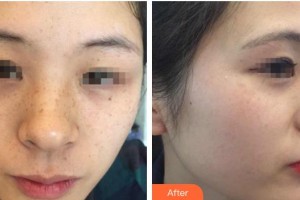 上海港華醫(yī)療美容醫(yī)院汪東華整形價(jià)格表附激光祛斑案例展示