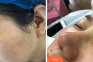 上海諾詩雅醫(yī)療美容醫(yī)院盧忠整形價格表附小蔡果酸案例展示