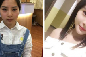 南京市六合區(qū)人民醫(yī)院燒傷整形科方箭整形價格表附顴骨內(nèi)推案例展示