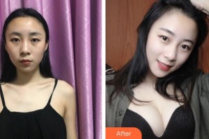 上海愛美醫(yī)療美容門診部童富江整形價格表附假體隆胸案例展示