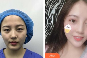 上海茸城女子醫(yī)院整形美容中心金志洙整形價格表附雙眼皮眼部手術(shù)案例展示