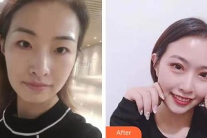 上海瑞麗整形美容醫(yī)院張炫整形價格表附眼部手術(shù)案例展示