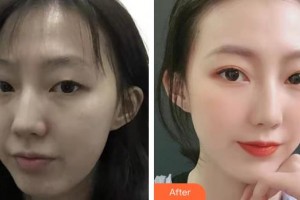 上海吳月蘭整形外科診所侯在恩整形價格表附眼部手術(shù)案例展示