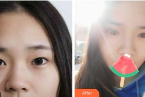 上海吳月蘭整形外科診所吳月蘭整形價格表附全切雙眼皮案例展示