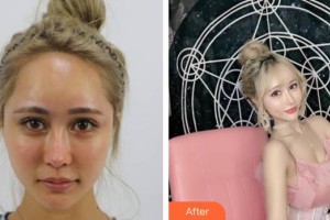 上海辰新醫(yī)院醫(yī)學(xué)美容科楊希鏸整形價格表附酒窩案例展示