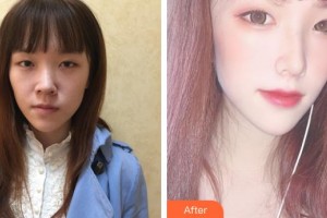 民航上海醫(yī)院整形外科莫建明整形價格表附美鼻部手術(shù)案例展示