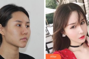 上海博愛醫(yī)院整形科彭少成整形價格表附頜面整形案例展示