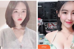 上海申江醫(yī)院整形美容科叢菊芝整形價格表附高端假體隆胸案例展示